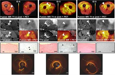 Simultaneous 18-FDG PET and MR imaging in lower extremity arterial disease